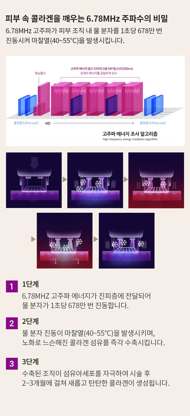 써마지 시술 원리 : 피부 속 콜라겐을 깨우는 6.78MHz 주파수의 비말