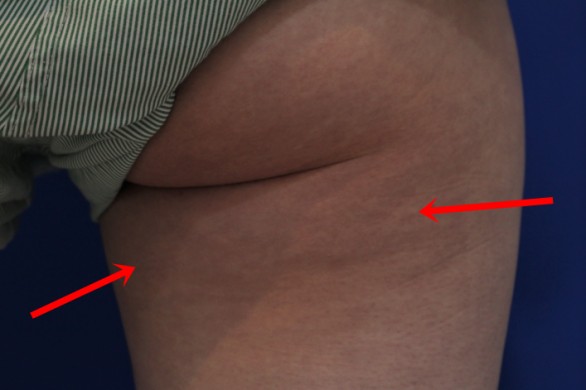 바디울쎄라 + 셀라부스터를 이용한 셀룰라이트 제거 : 시술후 사진