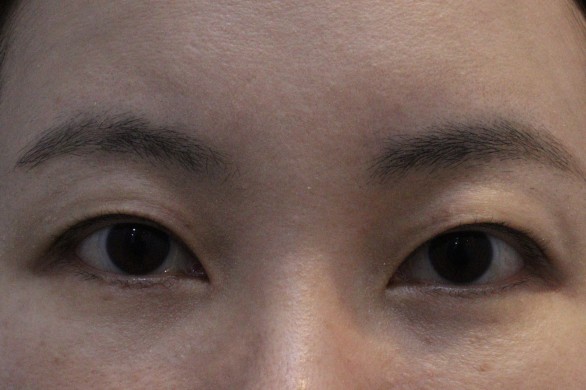 시술 후 붓기와 눈 멍, 붓기침·붓기약침 회복 관리 사례 : 시술후 사진