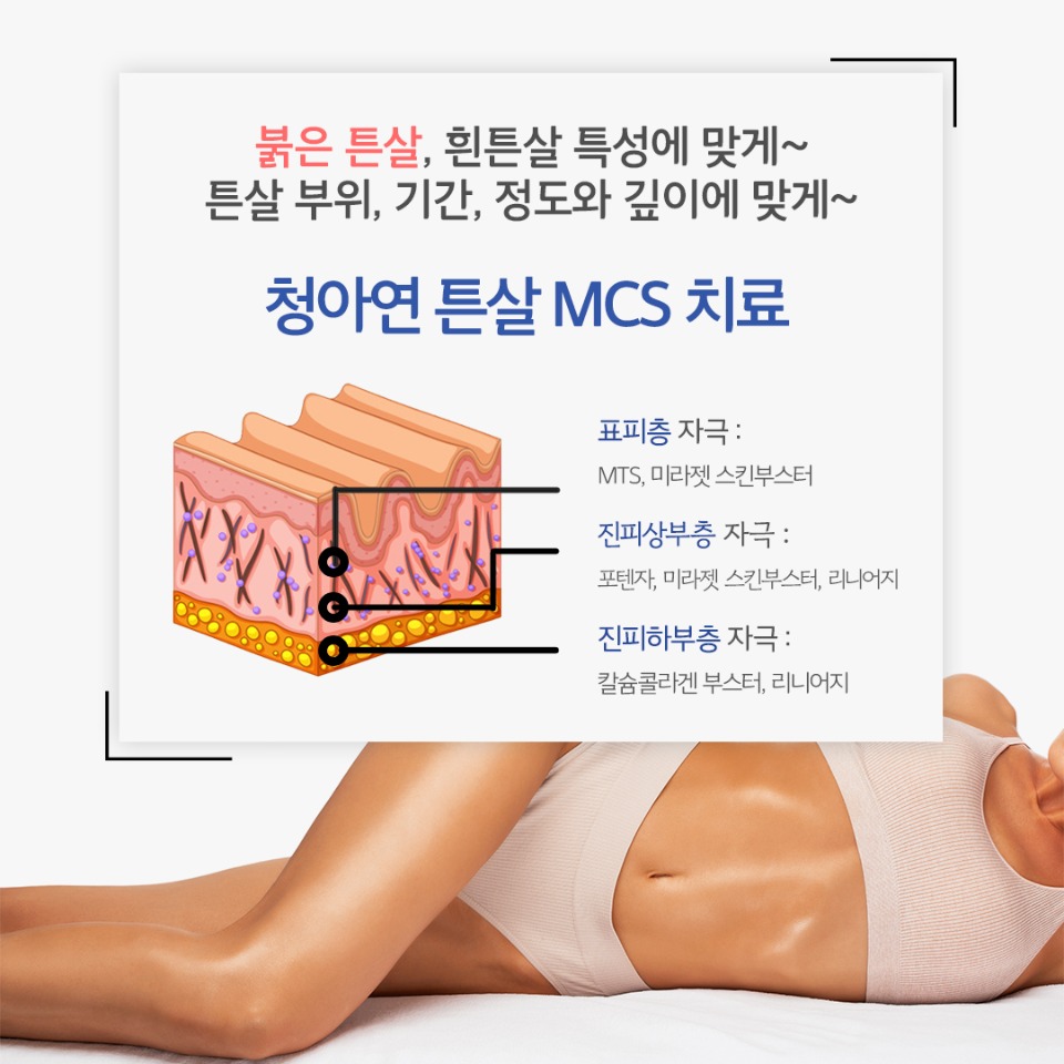 튼살-MCS4.jpg