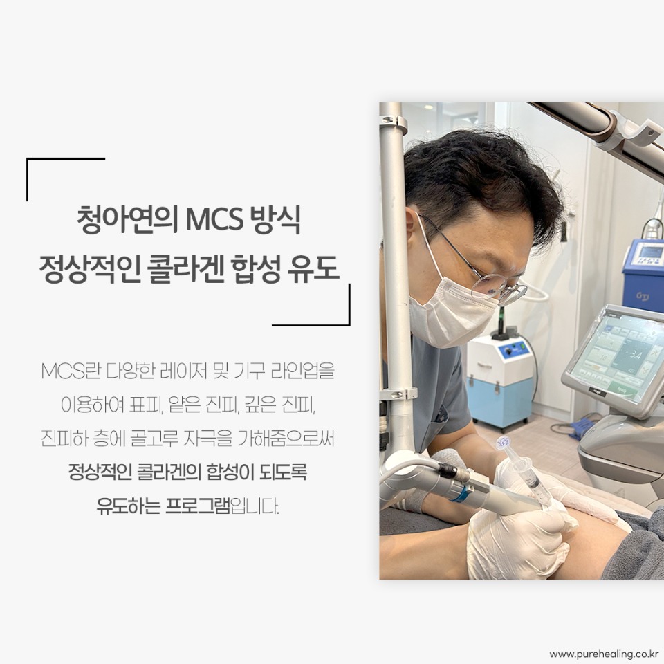 튼살-MCS3.jpg